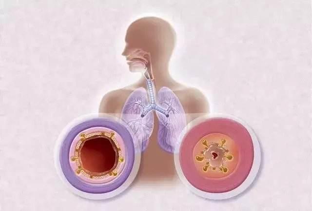 1700637880157098.jpg 支气管炎 (1).jpg