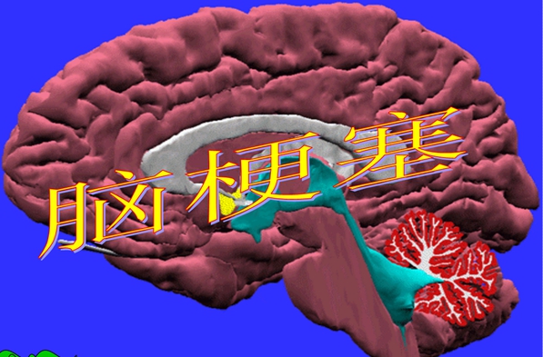 脑梗塞 (1).jpg
