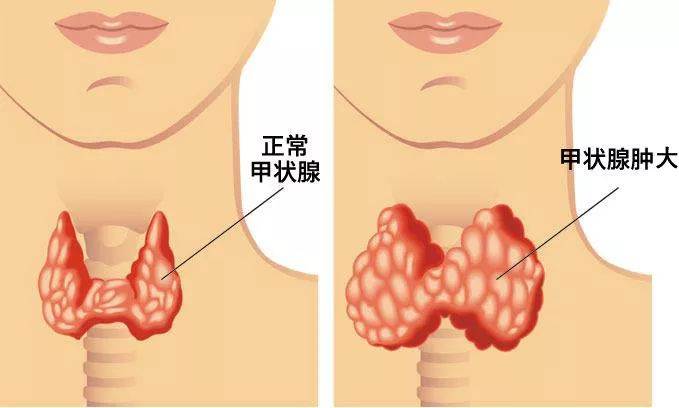 甲状腺.jpg