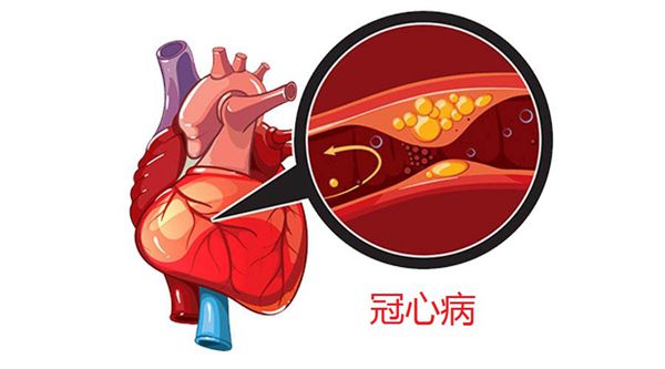 冠心病.jpg