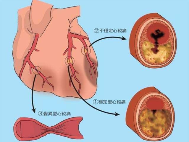 冠心病.jpeg