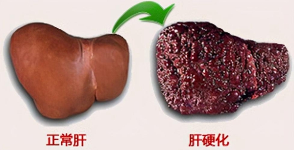 肝硬化.jpeg