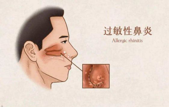 过敏性鼻炎.jpeg
