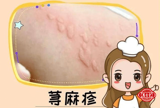荨麻疹.png