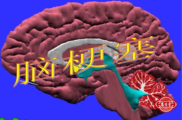 脑梗塞 (1).jpg