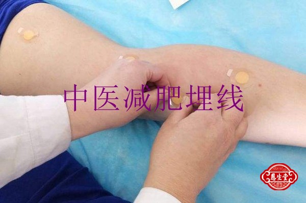 减肥埋线.jpg