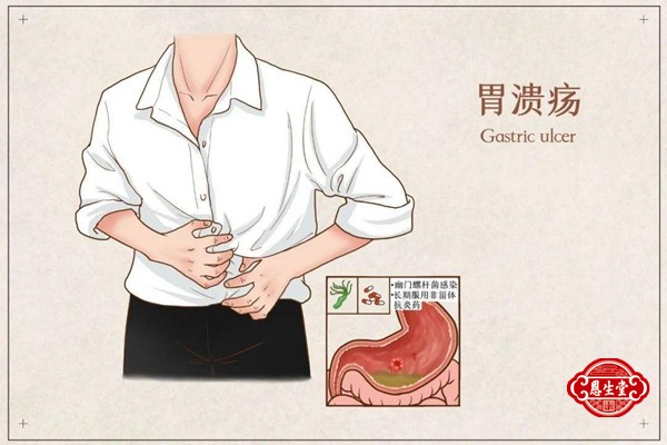 胃溃疡 (4)06.jpg