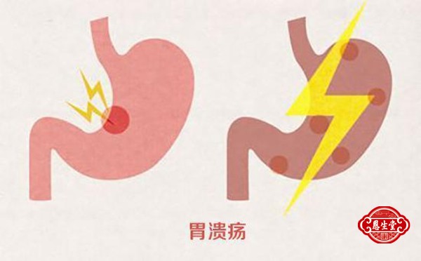 胃溃疡 (6)08.jpg