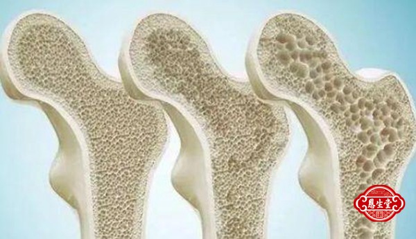 骨质疏松 (6)12.jpg