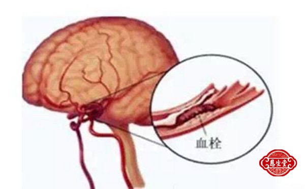 1709446159197192.jpg 脑动脉硬化 (1)01.jpg