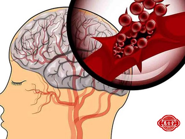 1709448382199288.jpg 脑动脉硬化 (4)07.jpg