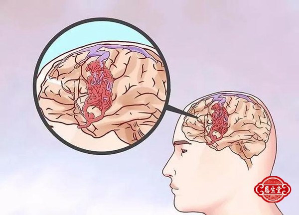 1709450107208270.jpg 脑动脉硬化 (8)11.jpg