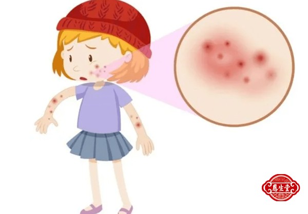 1709535503136890.jpg 湿疹 (1)03.jpg