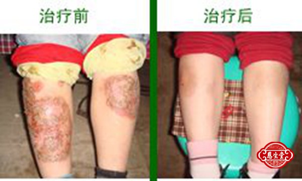 湿疹 (2)12.jpg