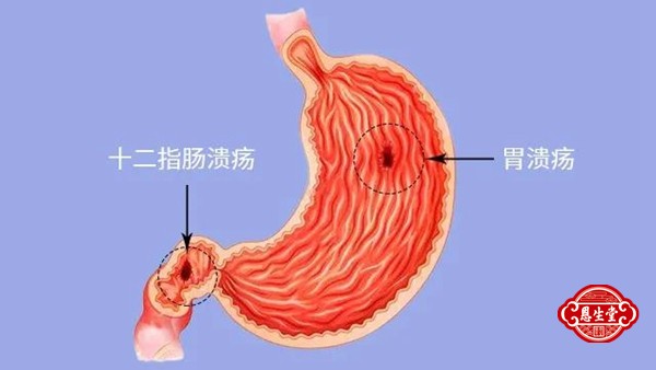 胃溃疡 (3)05.jpg