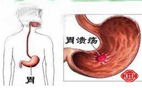 胃溃疡 (1)01.jpg