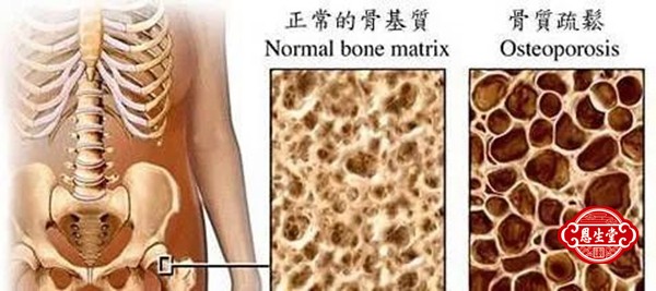 骨质疏松 (7)13.jpg