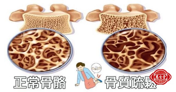 骨质疏松 (3)09.jpg