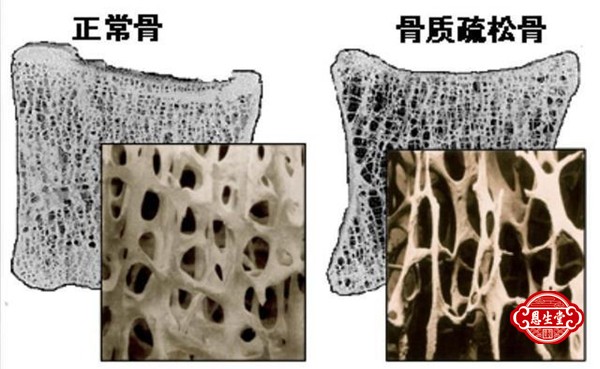 骨质疏松 (10)03.jpg