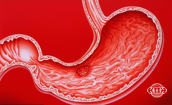 胃溃疡11.jpg
