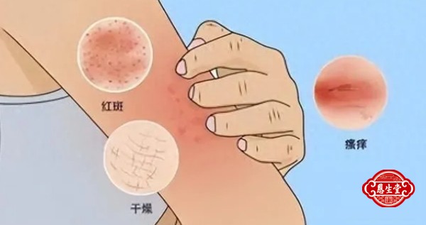 湿疹30.jpg