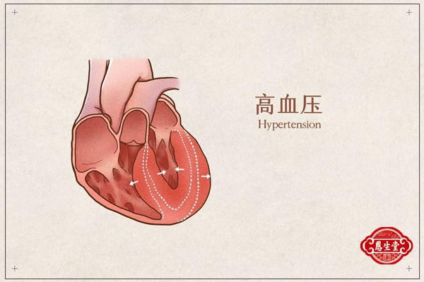 高血压心脏病.jpg