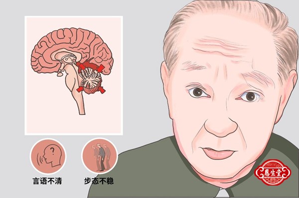 脑萎缩 (1)02.jpg