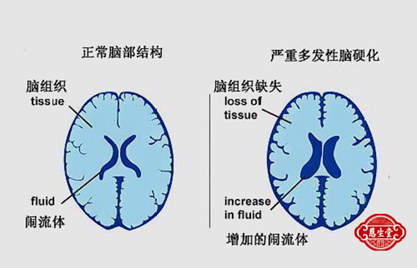 脑萎缩 (3)06.jpg