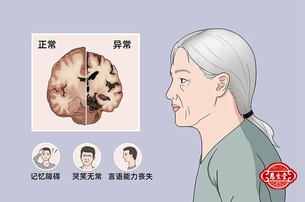 脑萎缩15.jpg