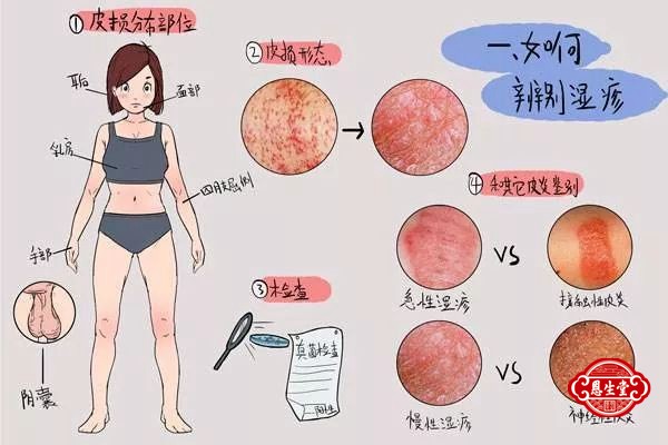 湿疹 (1)01.jpg