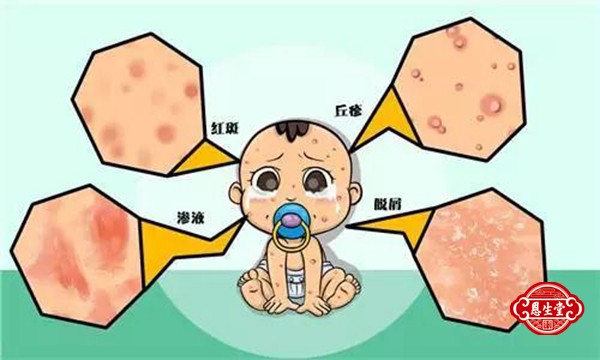 湿疹 (2)13.jpg