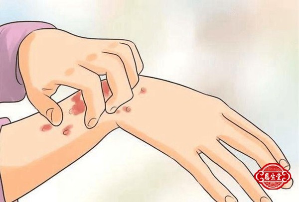 急性荨麻疹.jpg