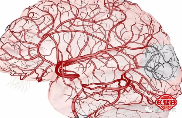 脑动脉硬化15.jpg