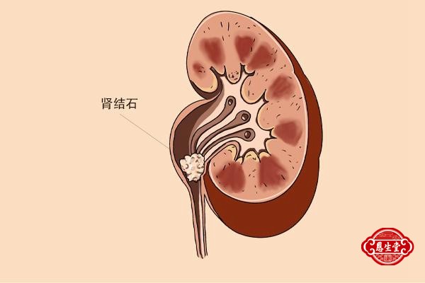 肾结石 (1).jpg