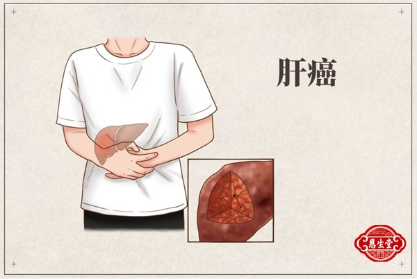 肝癌25.jpg