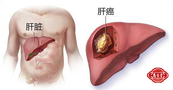 肝癌24.jpg