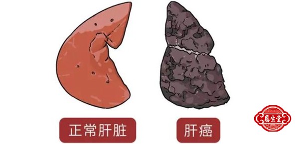 肝癌 (10)04.jpg