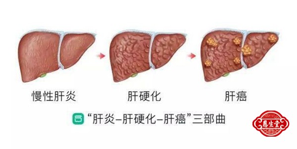 肝癌 (9)22.jpg