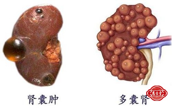 多囊肾 (2)03.jpg
