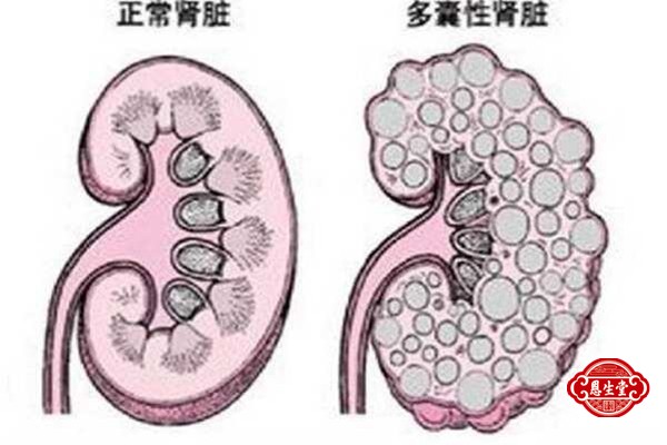 多囊肾 (2)04.jpg