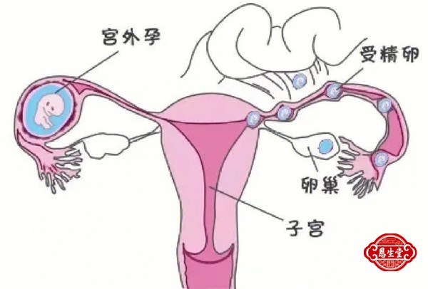 宫外孕 (1)02.jpg