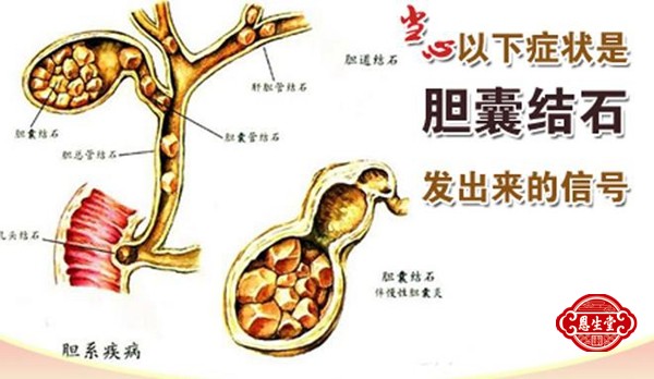 胆囊结石 (1)01.jpg