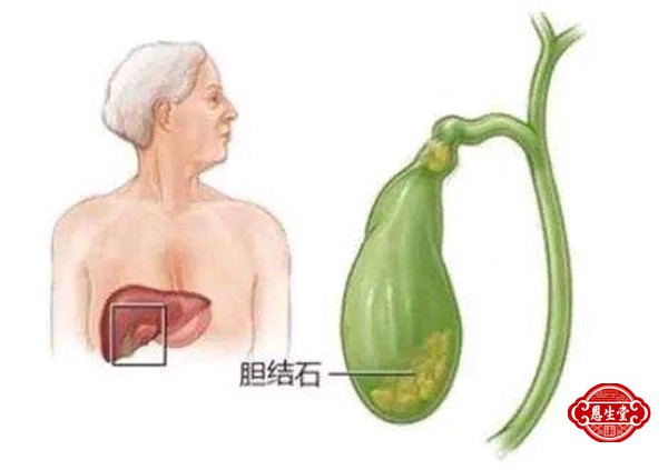 胆囊结石 (2)11.jpg