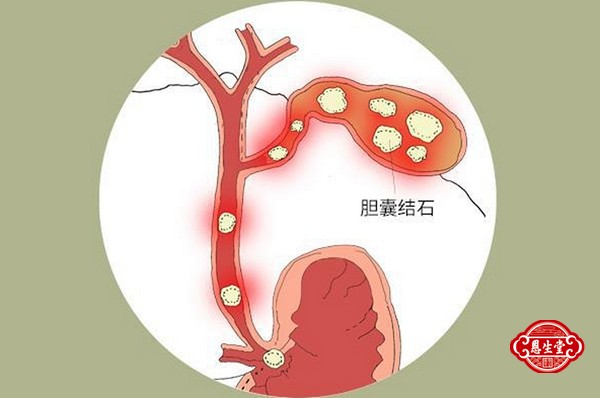 胆囊结石 (3)12.jpg