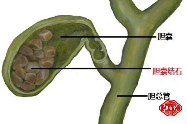 胆囊结石 (4)14.jpg