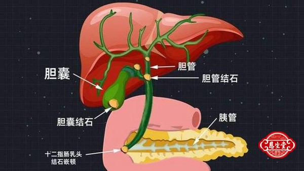 胆囊结石 (5)16.jpg