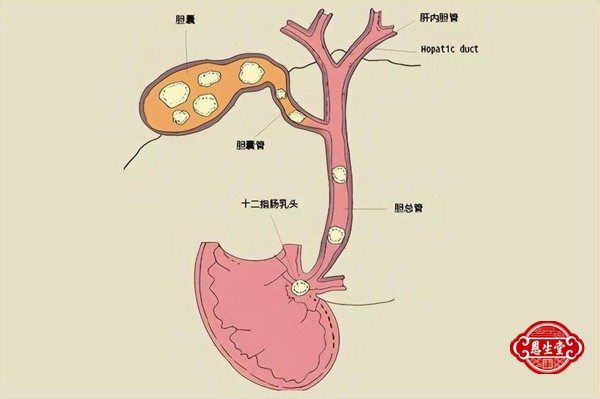 胆囊结石 (6)17.jpg