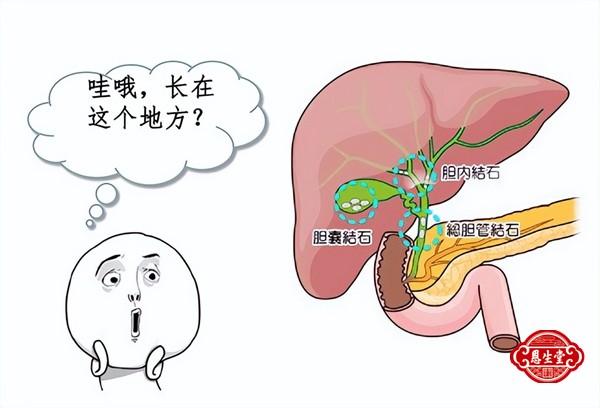 胆囊结石 (9)20.jpg