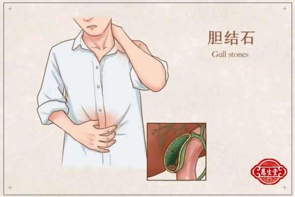 胆囊结石 (11)05.jpg