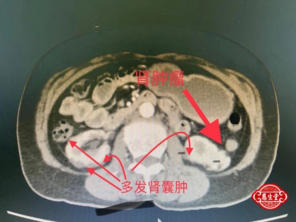 肾囊肿 (5)10.jpg
